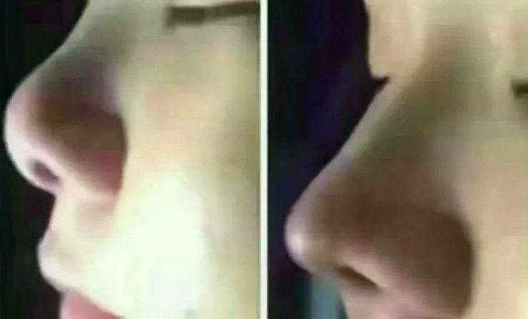 鼻部综合整形的价格