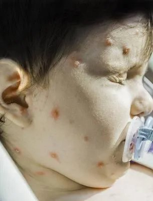 丹毒治疗方法有哪些