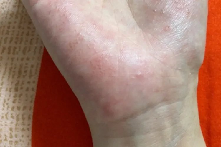 手部湿疹症状图片