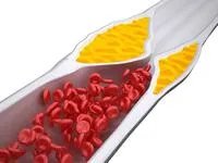 下肢动脉硬化闭塞症用什么药