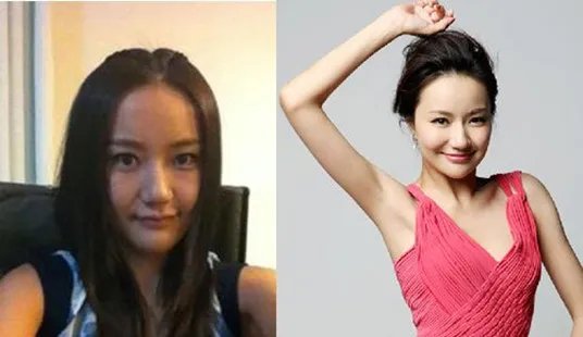阔太韩雨芹整容 整容前后差距大
