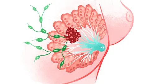 副乳增生是什么原因引起的