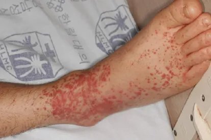 脚上紫癜初期的图片