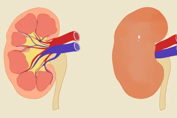 肾衰竭的早期症状表现