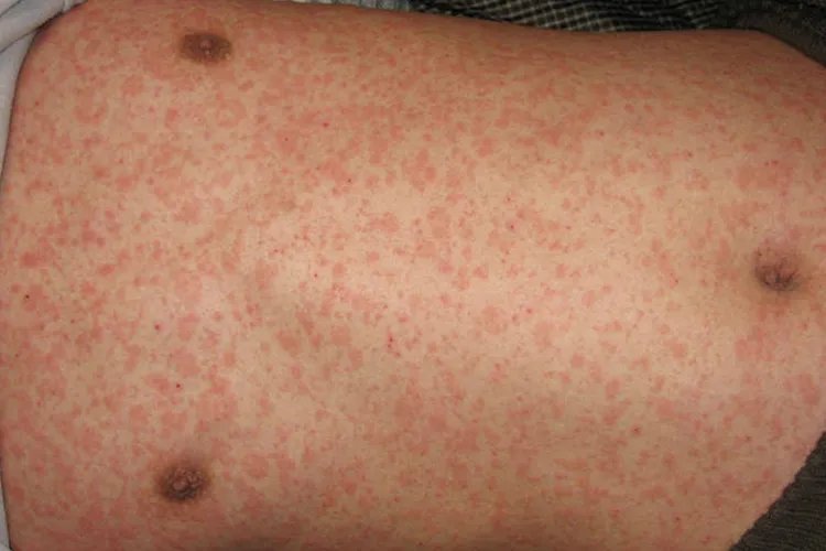 斑丘疹图片