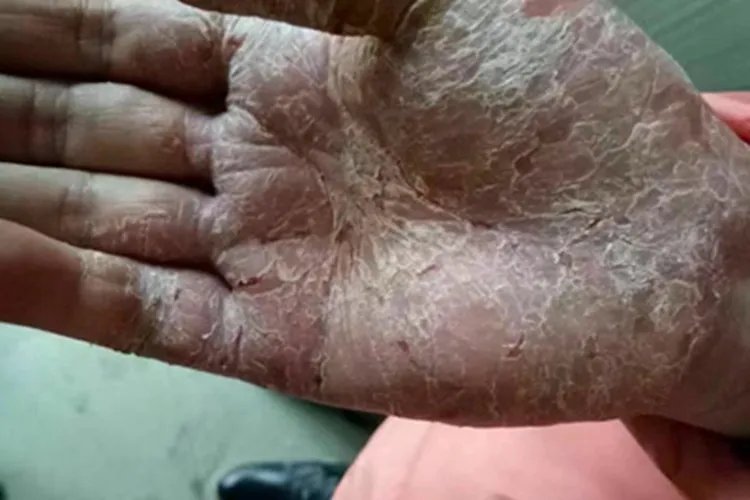 手部湿疹症状图片