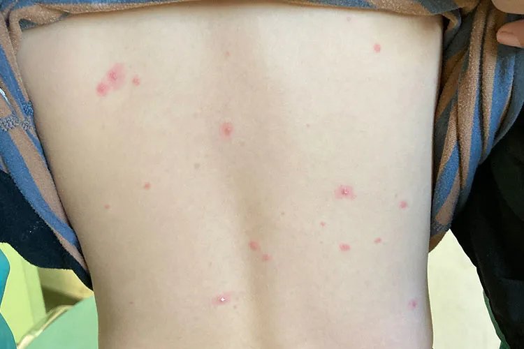 什么是水痘图片大全