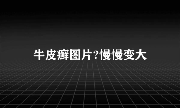 牛皮癣图片?慢慢变大