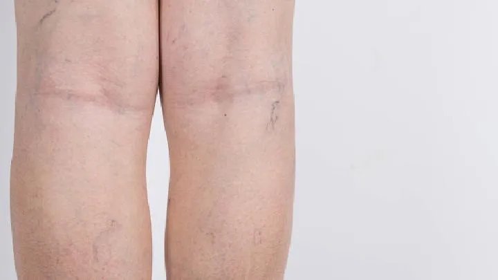 风湿与类风湿的区别是什么呢？