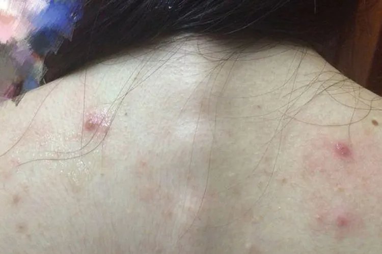 背部常见皮炎图片大全