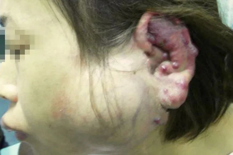 血管瘤有几种类型图片