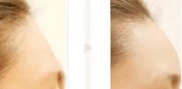 苏州好的丰额头整形医院在哪？