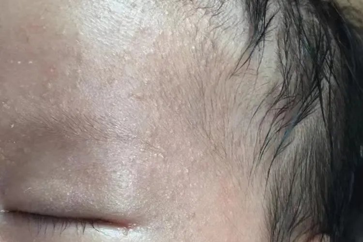 小孩身上痱子和湿疹的图片