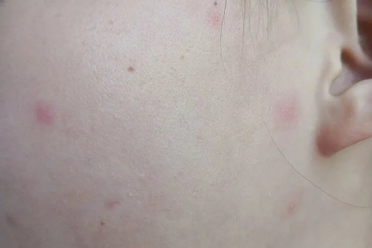 什么是水痘图片大全