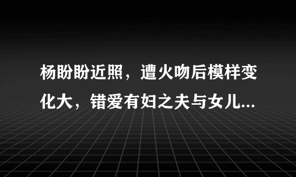 杨盼盼近照，遭火吻后模样变化大，错爱有妇之夫与女儿相依为命