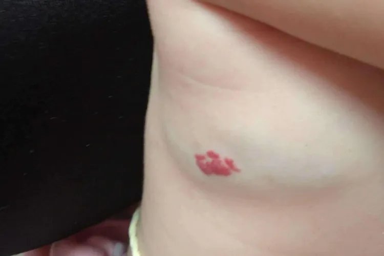 血管瘤有几种类型图片