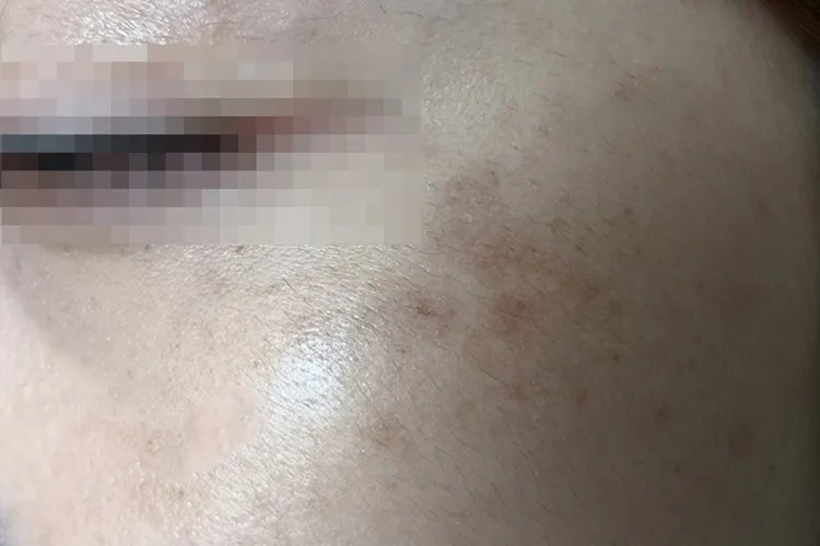 黄褐斑与晒斑最直观区别图片