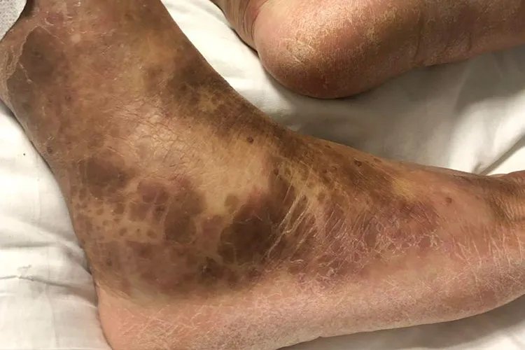 皮炎图片和症状