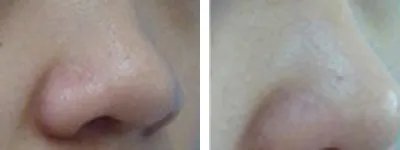 鼻头缩小术要多少钱