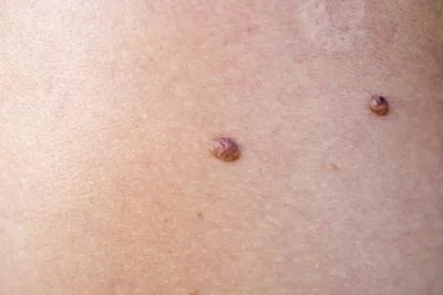 痣的形成原因有哪些