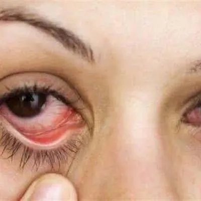 眼睛红是怎么回事
