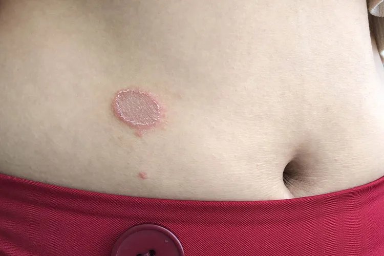 身上长癣的症状和图片