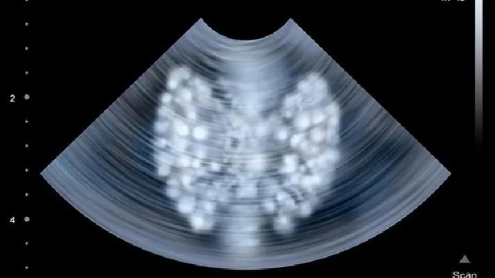 心脏移植是怎么回事呢