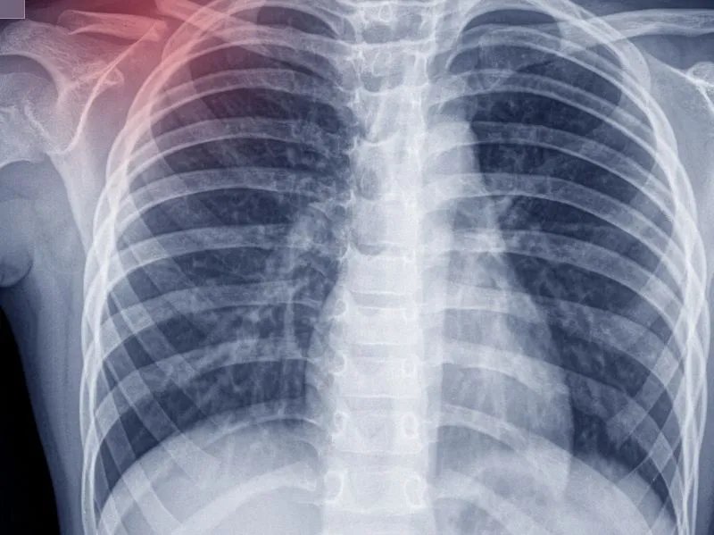 肺癌症晚期能活多久