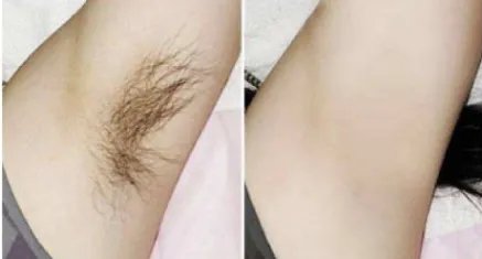 腋下脱毛都有哪些方法