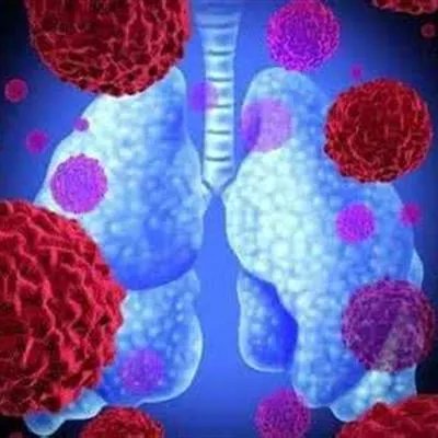 肺鳞癌手术大概多少钱?