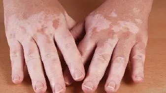 白癜风特效药是什么