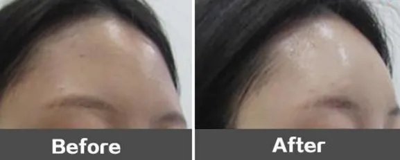 苏州好的丰额头整形医院在哪？