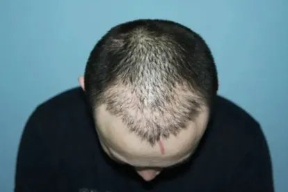 植发失败真实案例图片