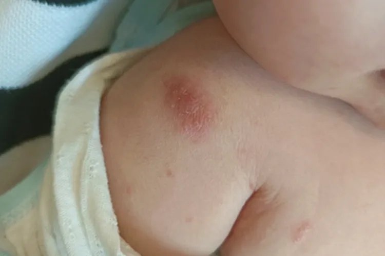 慢性湿疹症状图片