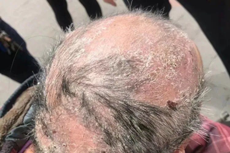 慢性湿疹症状图片