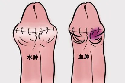割包皮水肿与血肿的区别图片