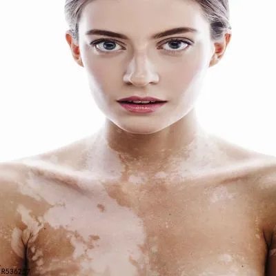 北京白癜风医院的治疗办法有哪些