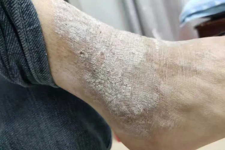 皮炎图片和症状