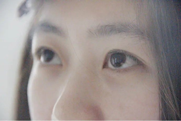 眼睛肿了怎么办