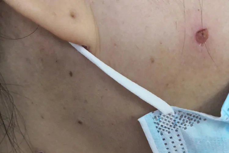 什么是水痘图片大全