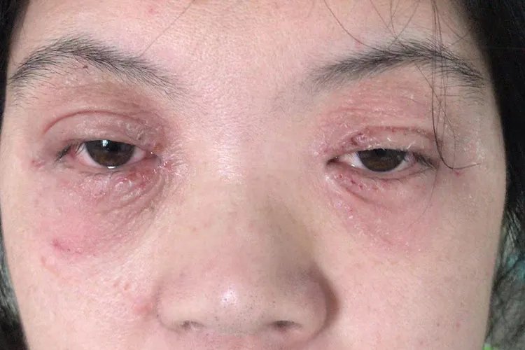 皮炎图片和症状