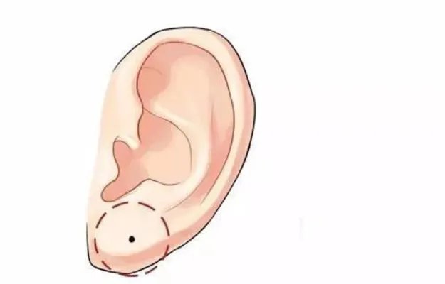 玻尿酸丰耳垂怎么样