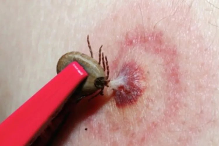 蜱虫咬人后的伤口图