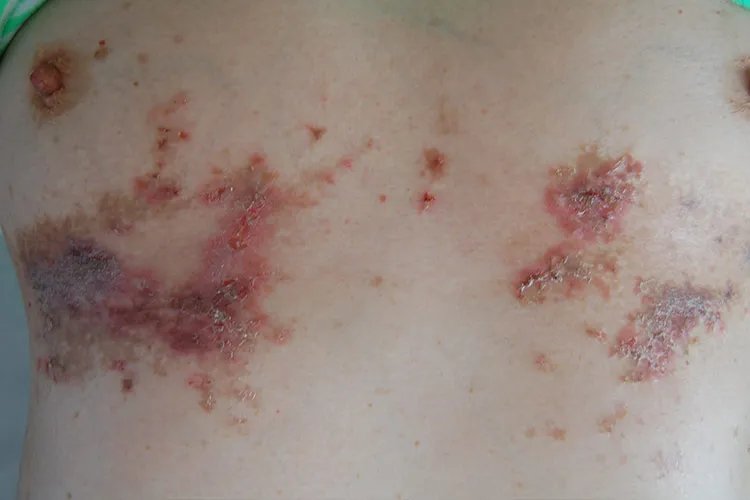 皮炎图片和症状