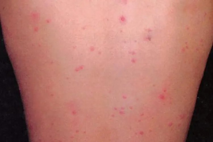 什么是水痘图片大全