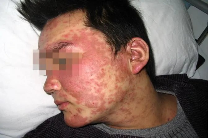 什么是系统性红斑狼疮图片