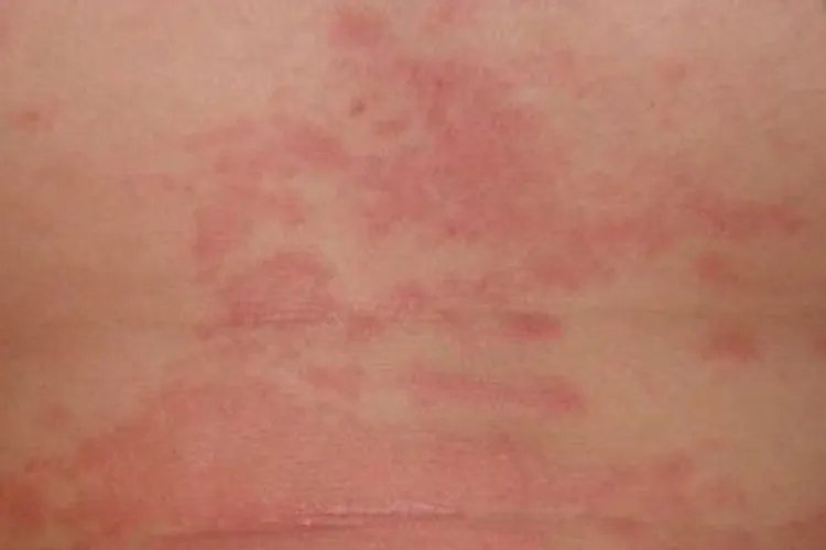 斑丘疹图片