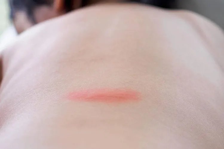 背部常见皮炎图片大全