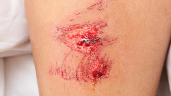 伤口感染化脓怎么办