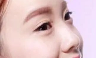 注射瑞蓝玻尿酸隆鼻价格